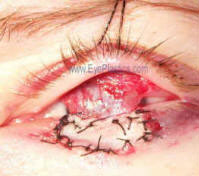 Intraoperative photo with tarsoconjunctival flap 